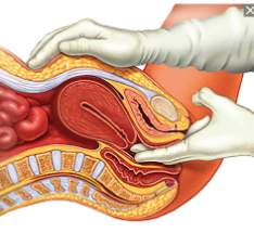 exame-como-descobrir-endometriose