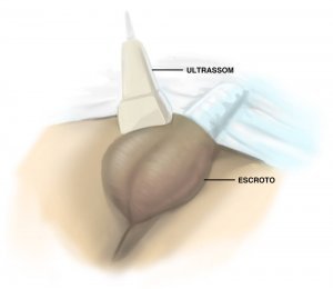 Como é feito ultrassom dos testículos