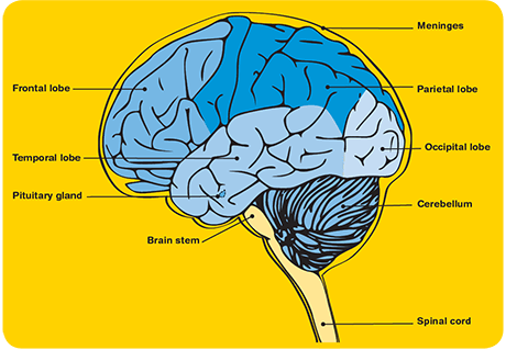 Tumor cerebral sintomas