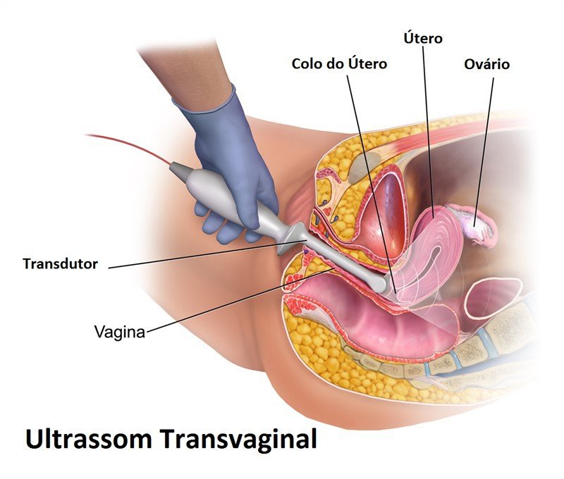 Transvaginal: como funciona e principais dúvidas