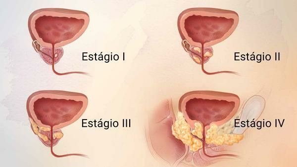 câncer de próstata sintomas etapa terminal