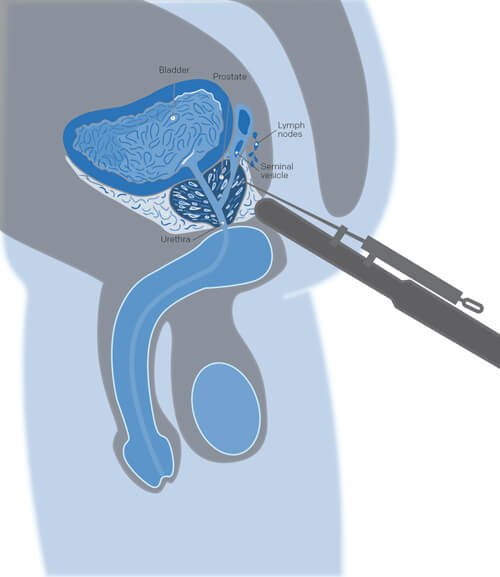 biopsia-prostata-como-e-feita