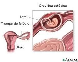 Resumo sobre gravidez ectópica