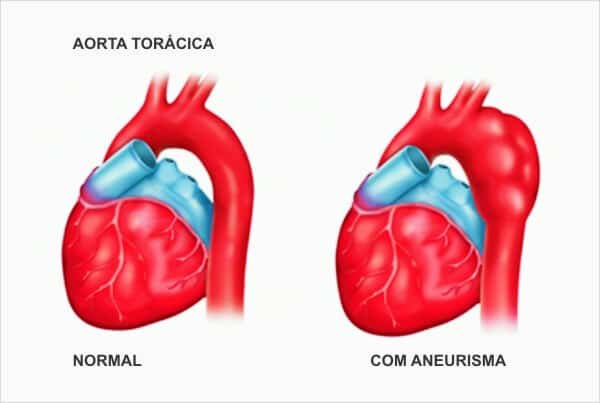 O que é aneurisma no coração