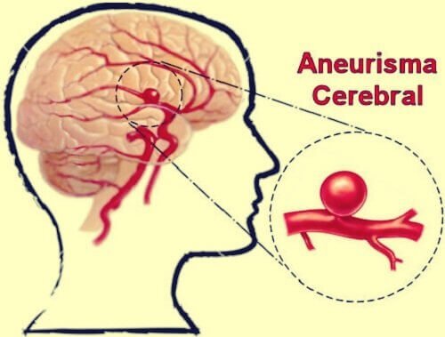 Tipos de aneurisma