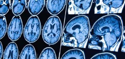 Tudo sobre tumor cerebral