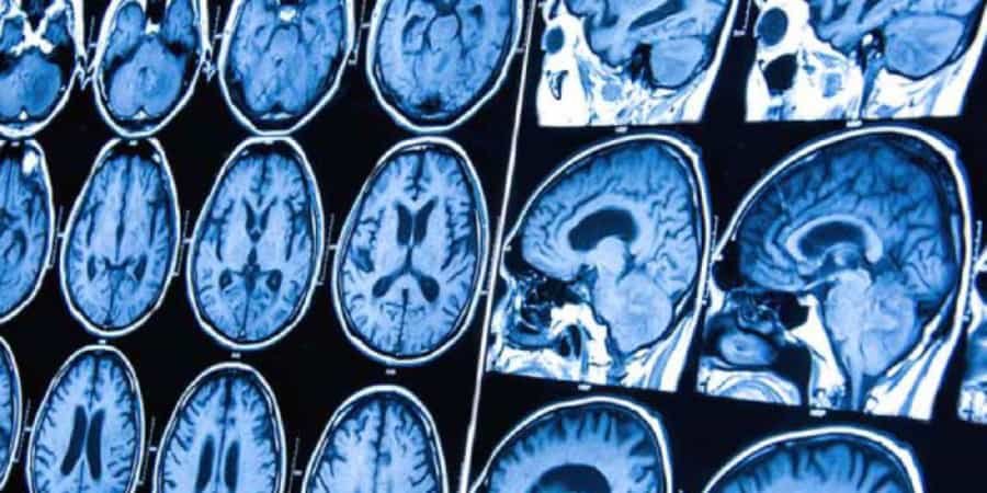 Tudo sobre tumor cerebral