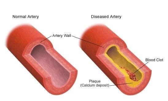 arteria-normal-arteria-doente