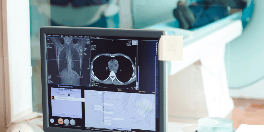 o-que-e-aneurisma-septo-interatrial