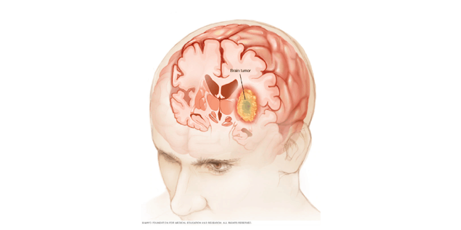 tipos-tumores-cerebrais