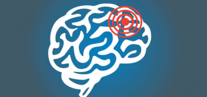 tratamentos-para-aneurisma-cerebral