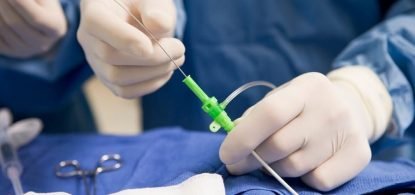 como-e-feita-cirurgia-aneurisma-cerebral