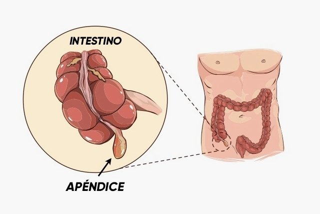 O Que é Apendicite Aguda Guia Dos Sintomas à Cirurgia 2452