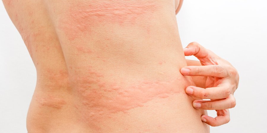 Intertrigo - Distúrbios da pele - Manual MSD Versão Saúde para a