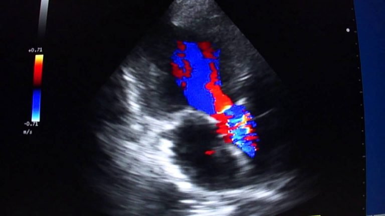 O Que é Ecocardiografia Com Doppler? Como é Feito O Exame?